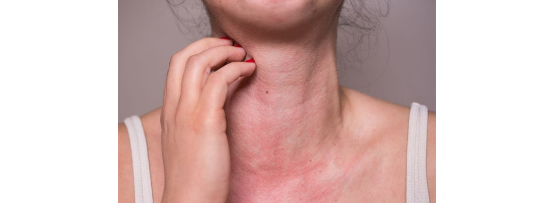 Itchy, red and irritated skin of the neck caused by a allergic reaction to a necklace